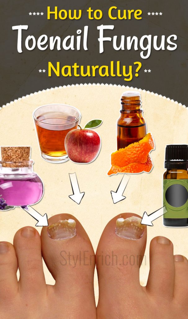 How to Cure Toenail Fungus Naturally?