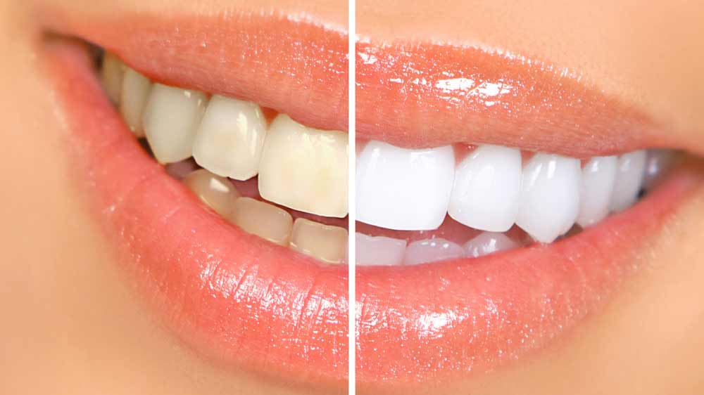 How to Naturally Whiten your Teeth at Home in 3 Minutes