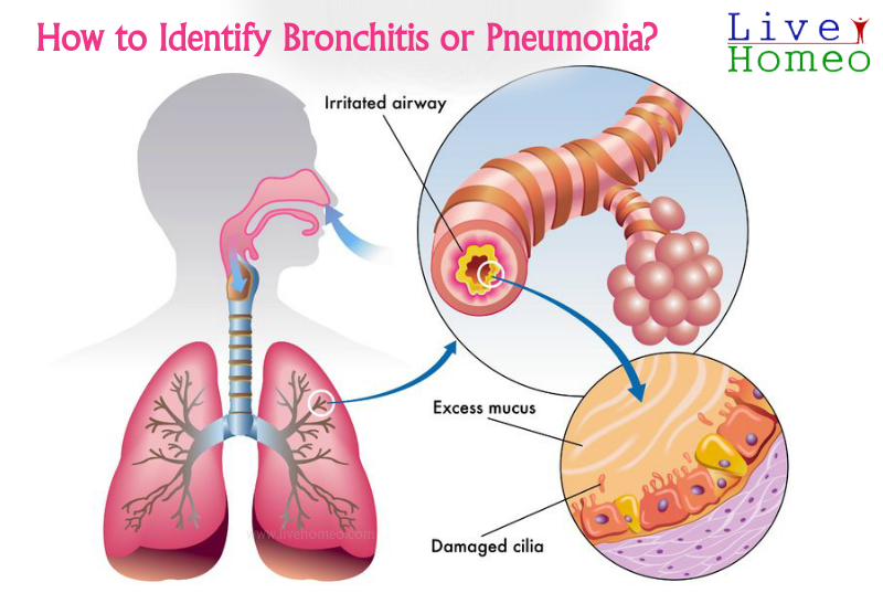 How To Tell The Difference Between Bronchitis And Pneumonia Sports Health And Wellbeing 9365