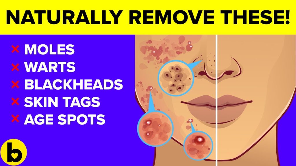 Destroy your Moles, Warts, Blackheads, Skin Tags and Age spots completely naturally