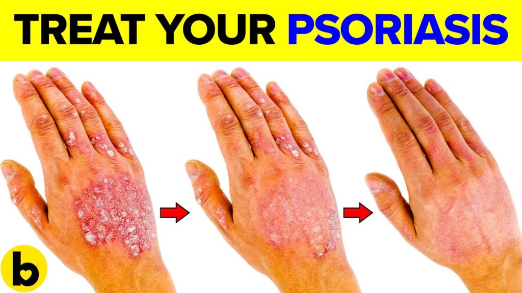 14 Foods that are Great for Fighting your Psoriasis