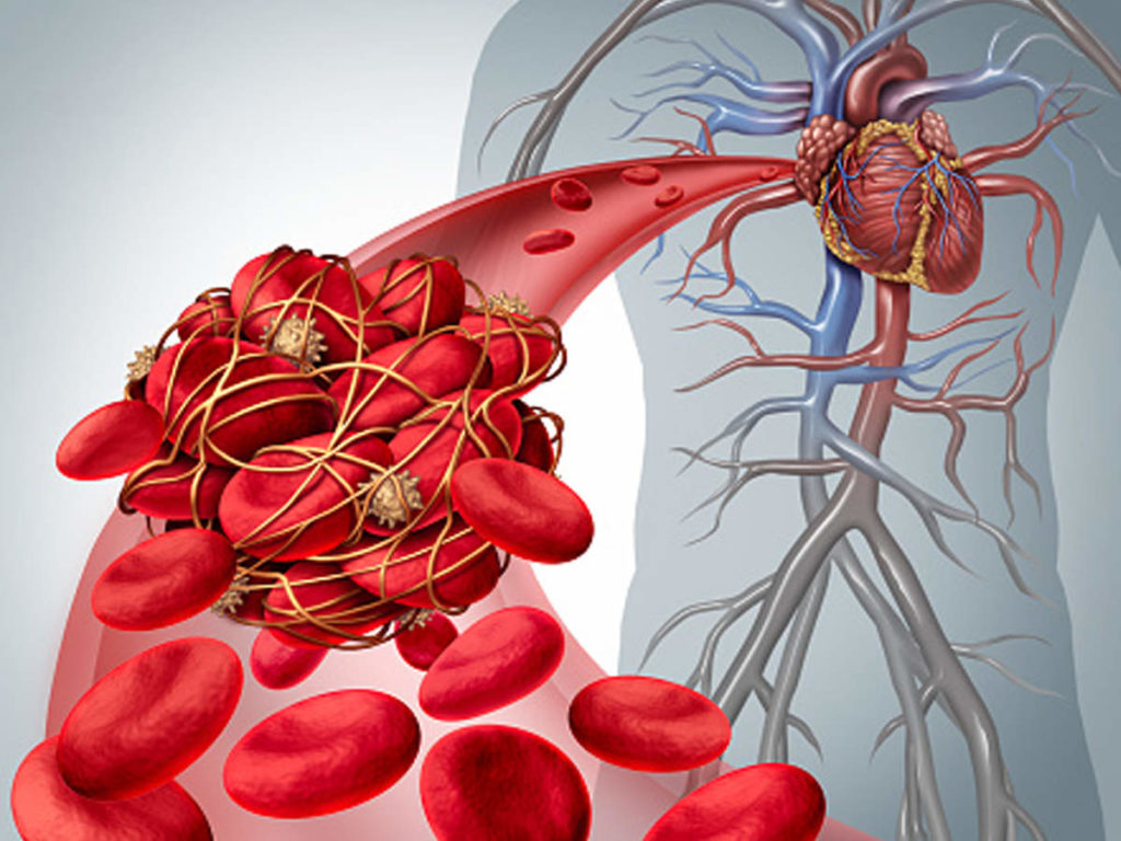 How to Stop a Blood Clot before it Starts